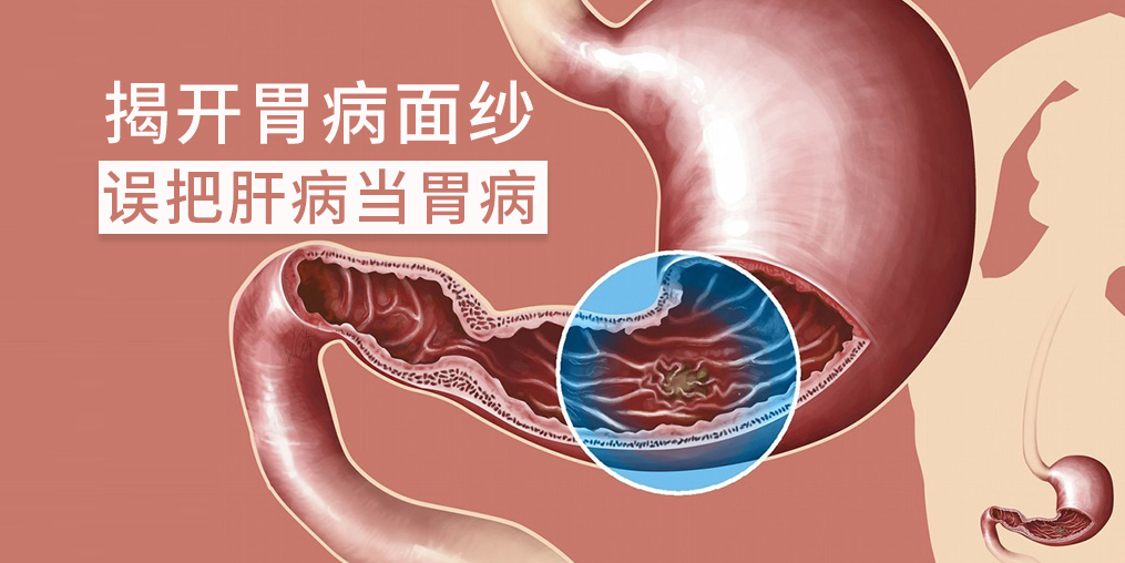 警惕“假胃病”，小心是肝有問題
